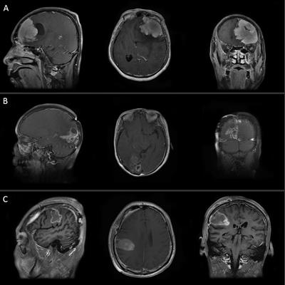 Analysis of Prognostic Factors of World Health Organization Grade Ⅲ Meningiomas